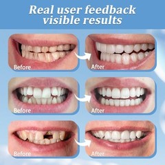 2 Pairs Smile Optimizing, Comfort Adjustable Upper & Lower Set, Unisex White